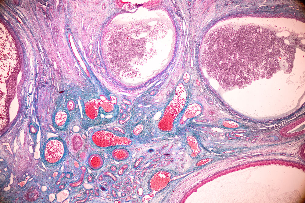 PCOS can make it harder to get pregnant. Natural medicine can help